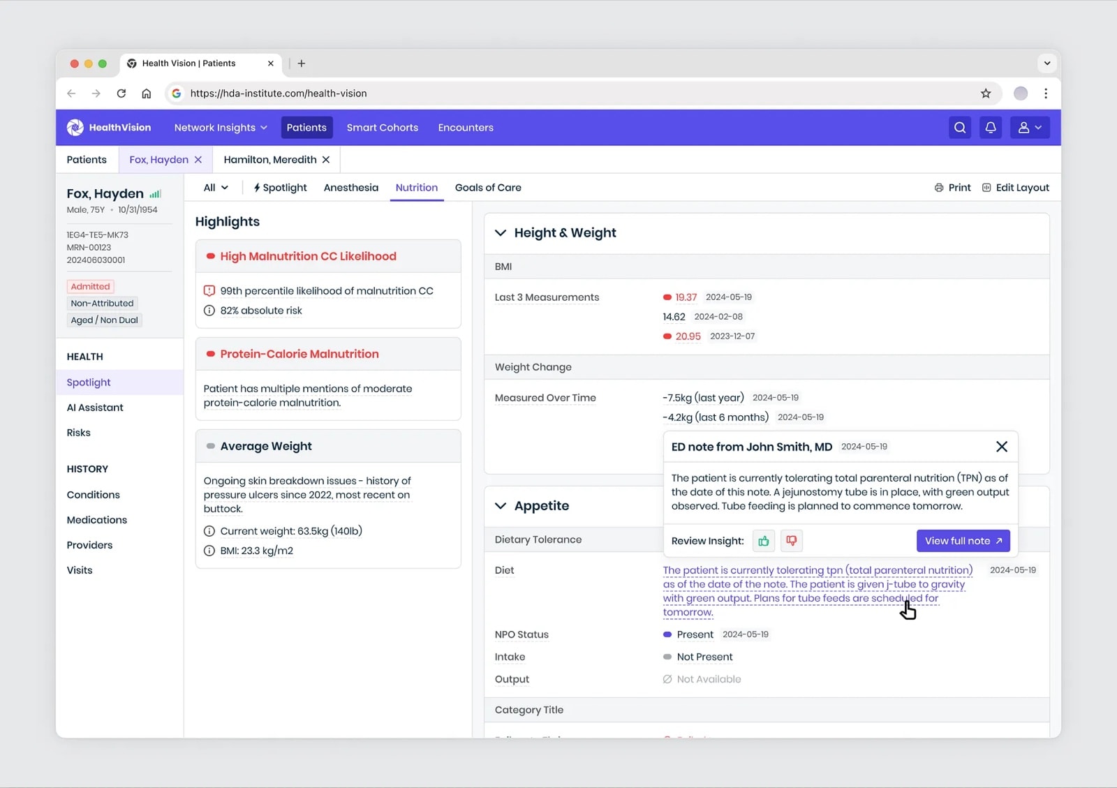 AI-generated nutrition summary with highlights for malnutrition risk, weight change over time and appetite, and an ED note opened from a linked sentence with a Review Insight control